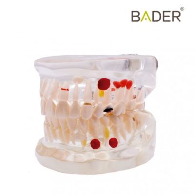 Modelo acrílico transparente caries