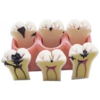 Modelo desmontable caries Bader