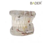 Modelo dental de implante con nervio