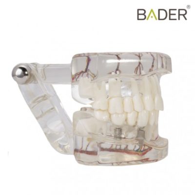 modelo-dental-de-implante-con-nervio-bader