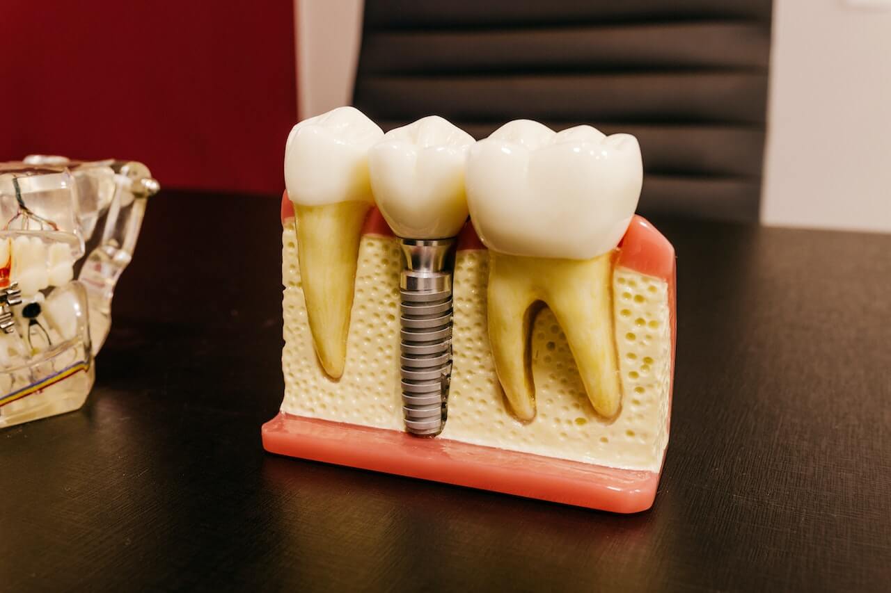 Motor de implantes dentales