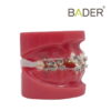 Modelo de bracket metálico y zafiro
