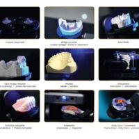 Ejemplo escaneado con Escáner dental extraoral 3D OS-GOLDY