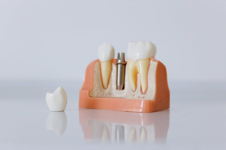 cuidado de implantes dentales