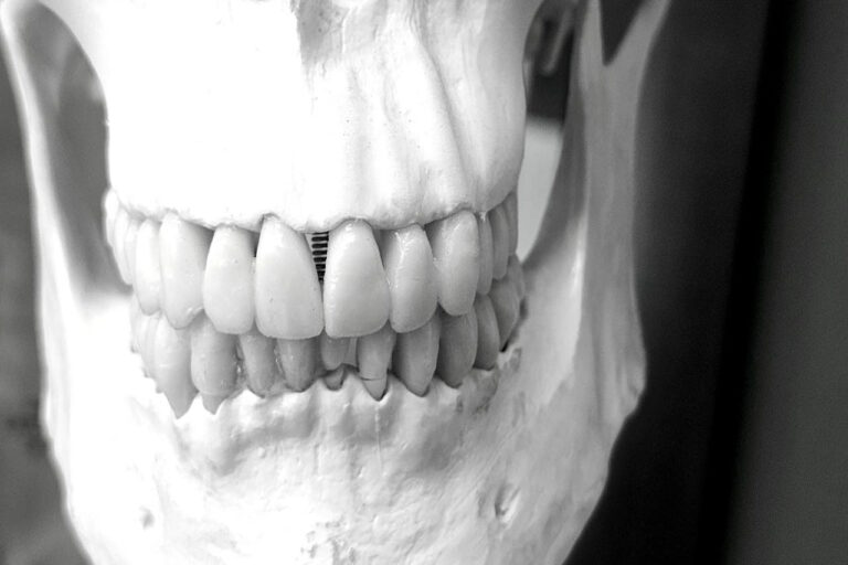 usos de la resina blanca para modelos dentales