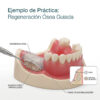 Fantoma Kim para Práctica de Regeneración Ósea